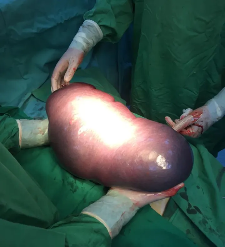 Splină de 6,5 kilograme, operată la Spitalul Județean din Baia Mare
