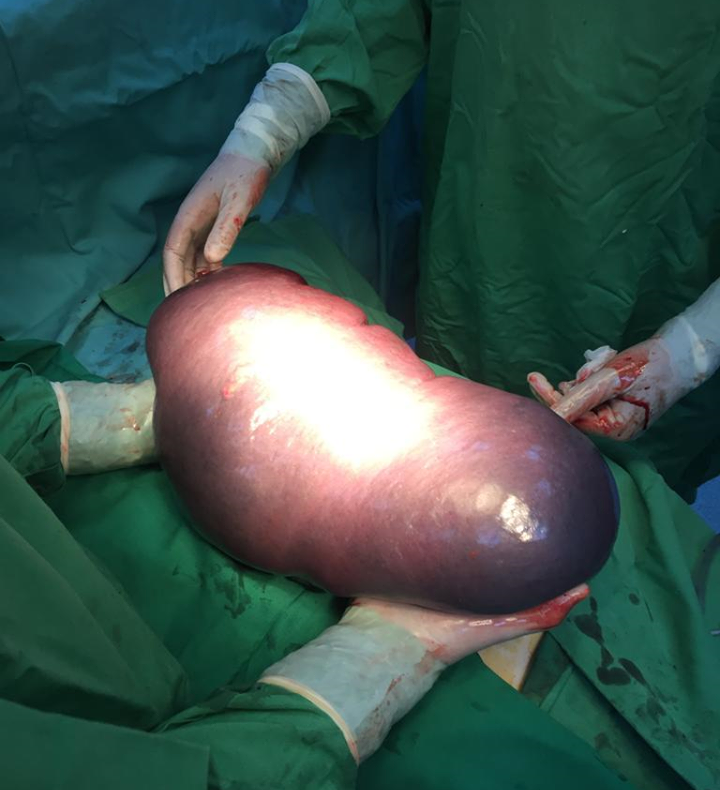 Splină de 6,5 kilograme, operată la Spitalul Județean din Baia Mare