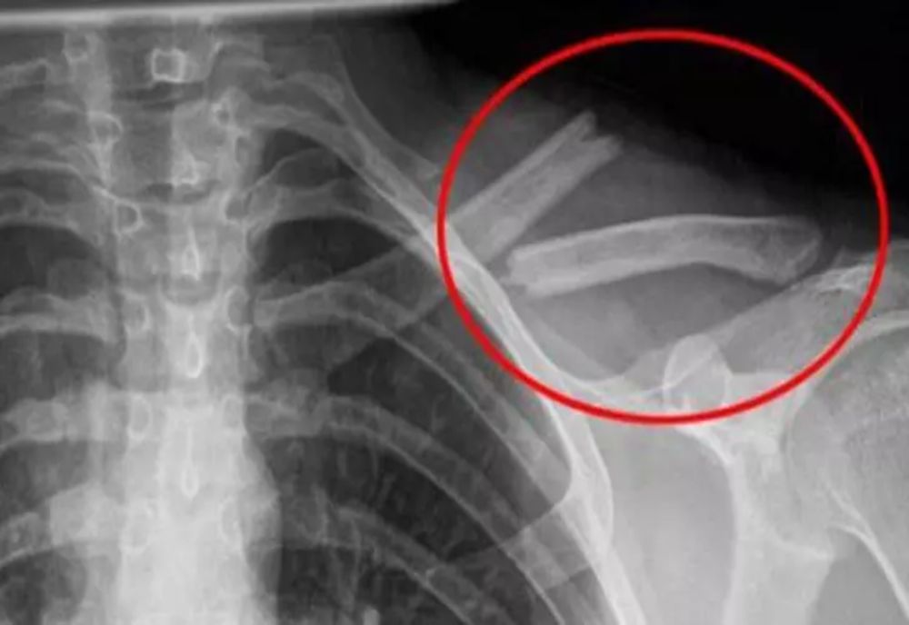 Otrava asta îţi distruge oasele! O bei în fiecare zi fără să știi cât de toxică este pentru organism