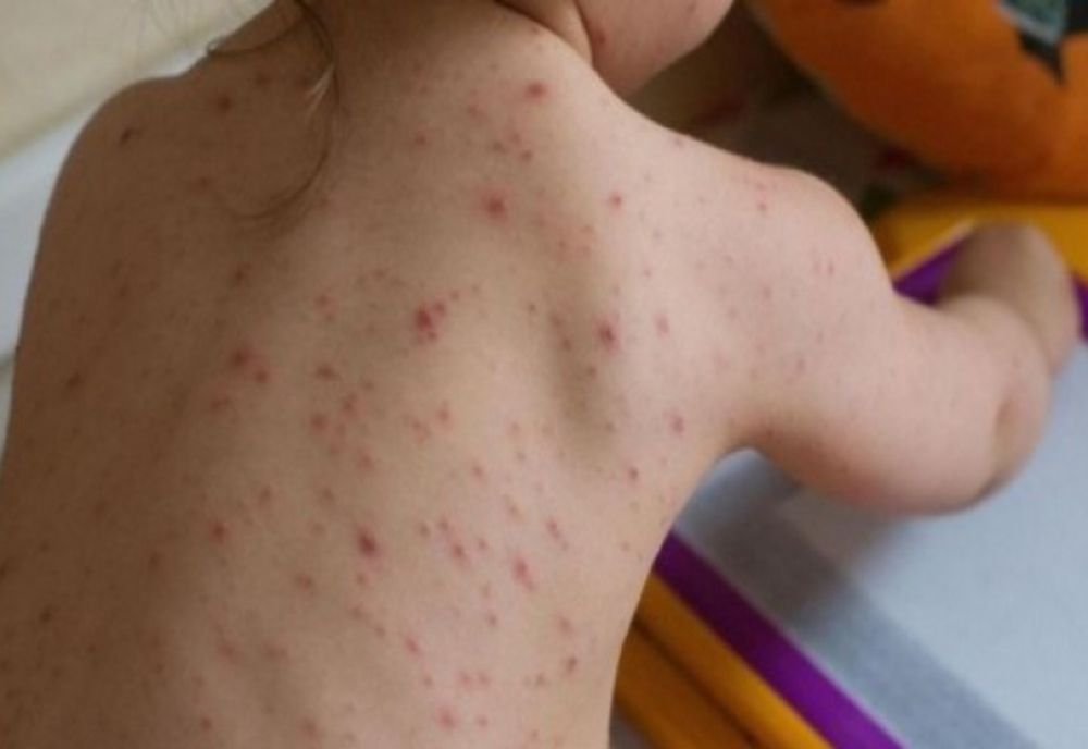 INSP: Peste 650 de cazuri noi de rujeolă înregistrate în ultima săptămână