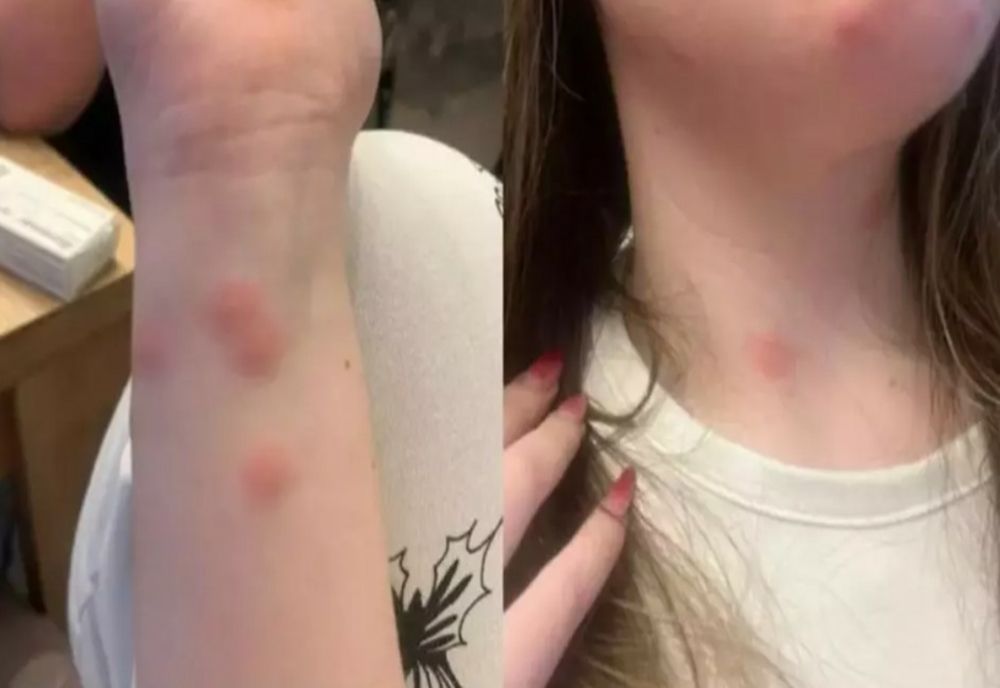 Condiții jalnice în trenul București–Sighet. O tânără a ajuns la spital după ce a fost mușcată de ploșnițe într-un vagon cușetă